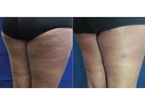 BodyFX 6 sm