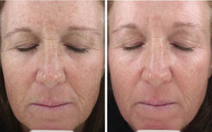 FineLines Wrinkles 01