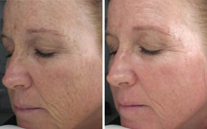 FineLines Wrinkles 02