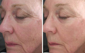 FineLines Wrinkles 04