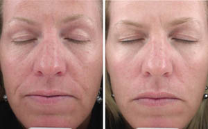FineLines Wrinkles 05