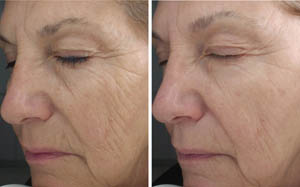 FineLines Wrinkles 06