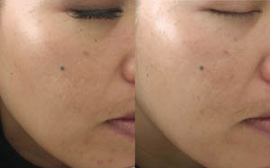 Hyperpigmentation 01
