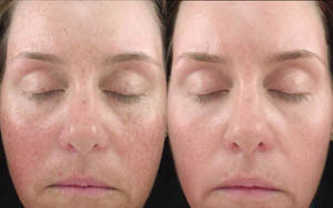 Hyperpigmentation 02