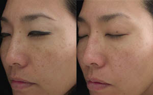 Hyperpigmentation 05