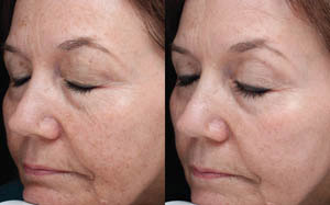 Hyperpigmentation 06