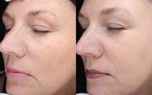 Hyperpigmentation 07