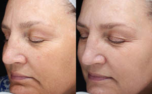 Hyperpigmentation 08