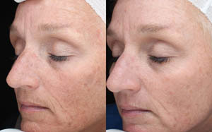 Hyperpigmentation 09