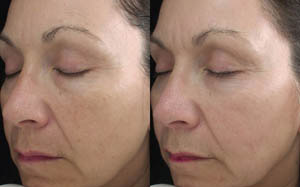 Hyperpigmentation 10