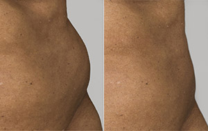 Sculpsure 01 sm 1