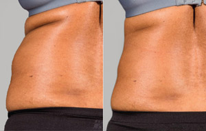 Sculpsure 02 sm 1