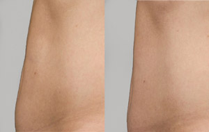 Sculpsure 03 sm 1