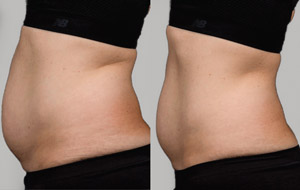 Sculpsure 04 sm 1