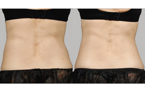 Sculpsure 05 sm 1