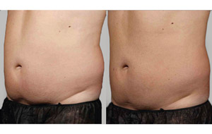 Sculpsure 06 sm 1
