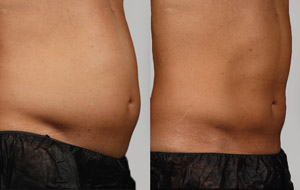 Sculpsure 07 sm 1