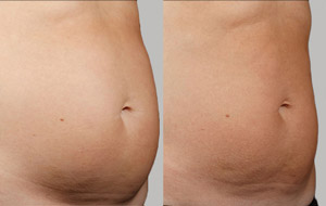 Sculpsure 08 sm 1