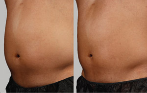 Sculpsure 09 sm 1