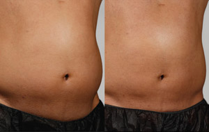 Sculpsure 10 sm 1