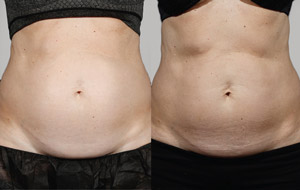 Sculpsure 11 sm 1