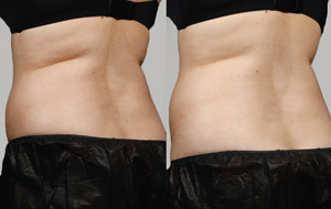 Sculpsure 12 sm 1