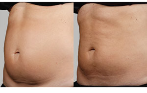 Sculpsure 14 sm 1