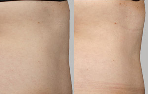 Sculpsure 15 sm 1