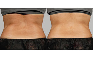 Sculpsure 17 sm 1