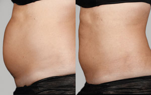 Sculpsure 18 sm 1