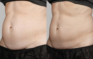Sculpsure 19 sm 1