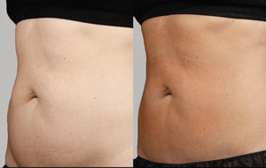 Sculpsure 21 sm 1
