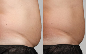Sculpsure 22 sm 1