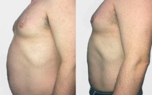 body contouring