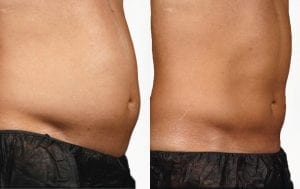 sculpsure