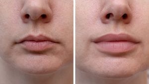 Lip filler before after
