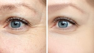 eye wrinkles before after