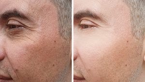 man eye wrinkles before and after