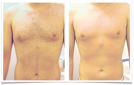 BA chest