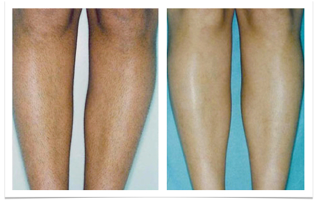 BA legs