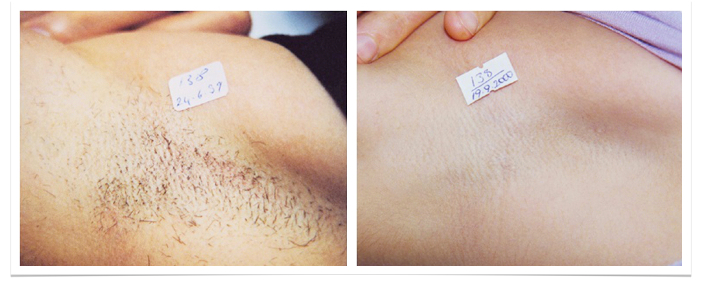BA underarm final