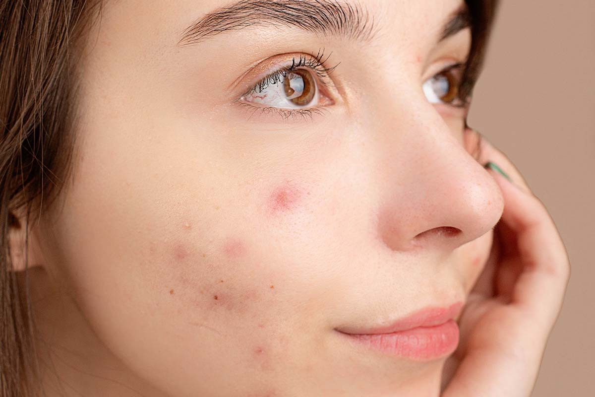 Acne