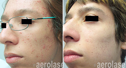 Acne4 Pair