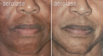 Melasma2 Pair