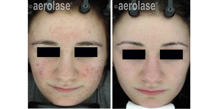 NeoClear Acne 3 Months After 5 Treatments David Goldberg MD