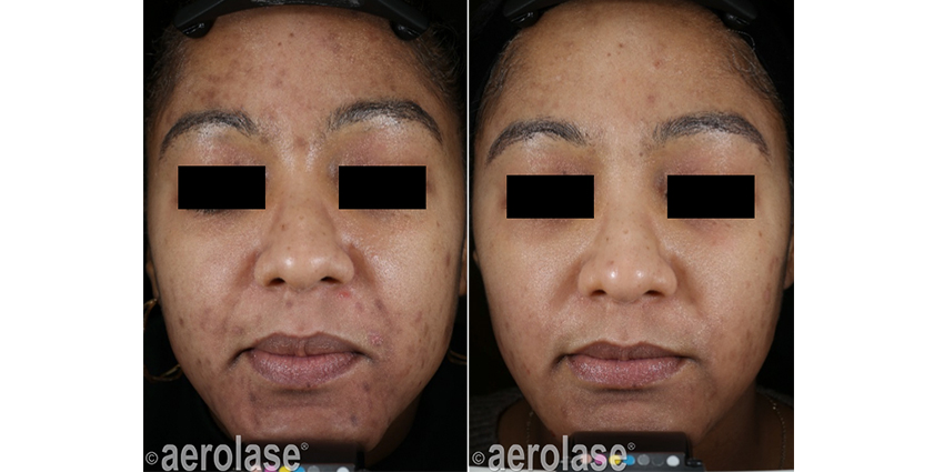 NeoClear Acne 5 Months After 3 Treatments David Goldberg MD