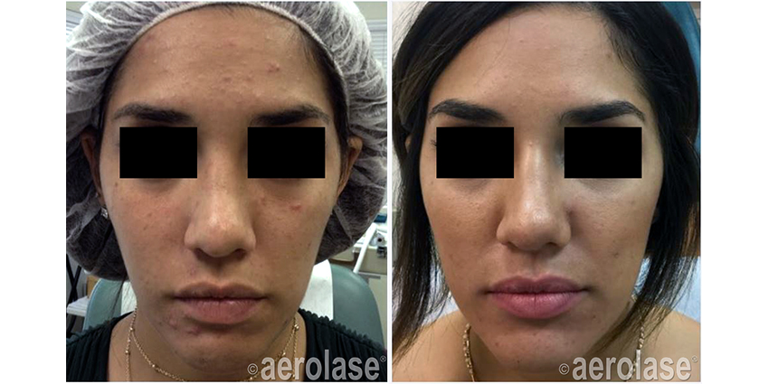 NeoClear Acne After 4 Treatments Mark Nestor MD