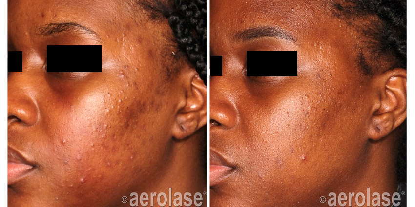 NeoClear Acne After 4 Treatments Michelle Henry MD