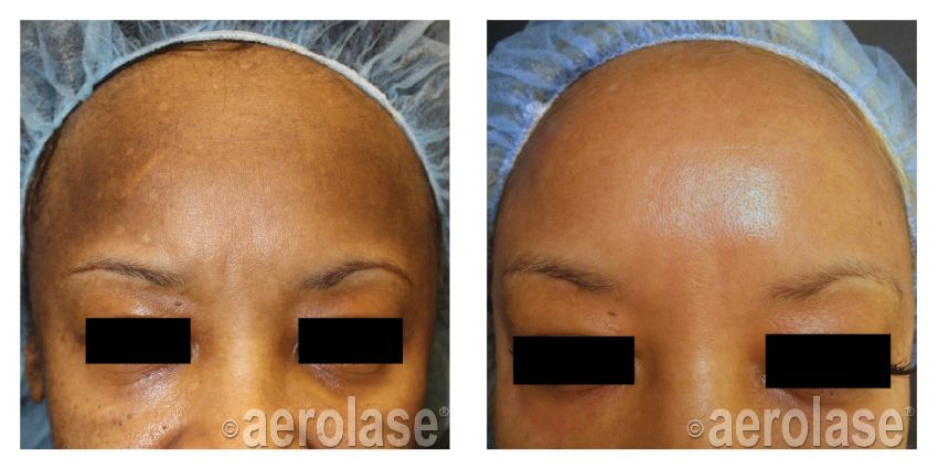 NeoSkin Melasma After 1 Treatment combined with Glycolic Peel Cheryl Burgess MD