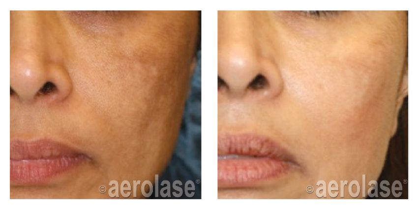NeoSkin Melasma After 1 Treatment combined with Hydroquinone Cheryl Burgess MD